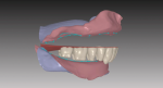 Fig 13. Mandibular teeth are set to the virtual template in relation to ridge crest lines to conduct occlusal vector force analysis.