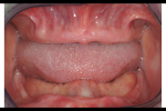 Fig 16. The edentulous oral environment showing horizontal forces of tongue and cheek. Ability to visualize lost bone, tissue, and dentition before treatment has begun is critical to successful outcomes.