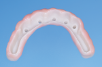 Fig 9. The zirconia shell is based on PMMA provisional and analog-produced metal bar.