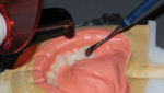 Fig 3. Use hand instruments to tack the eFiber to the teeth and smooth out to the desired position.