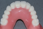 Fig 10. Both fibers and mesh are undetectable when the denture is polished to a high shine.