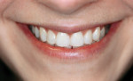 Figure 3  Composite bonding closed diastemas and reshaped teeth.