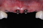 Fig 6. Frontal view of 4 implants placed at the central incisor and canine sites to replace the missing 6 anterior maxillary teeth. Multi-unit abutments have been torqued on the implants. before insertion of the segmented rehabilitation.