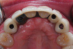 Fig 2. Occlusal view of definitive segmented rehabilitation with single implant crowns in the canine region and FDP extending from lateral incisor to lateral incisor.