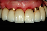 Fig 8. Frontal view of one-piece implant FDP, supported by 3 implant abutments, prior to insertion. The use of gingiva-colored ceramics was not necessary in this specific case. Instead, ovate pontics were employed.