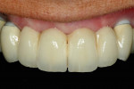 Fig 10. Frontal view of implant FDP, supported by two canine implants. The use of gingiva-colored ceramics was not necessary in this specific case.
