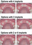 Fig 12. Schematic representation of different treatment options to replace six missing anterior maxillary teeth with implant single crowns and FDPs.