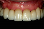 Fig 9. Frontal view of one-piece implant FDP insertion, supported by three implants.