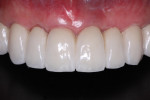 Fig 7. Frontal view of segmented rehabilitation with screw retention at the implant level, canine single crowns and screw-retained at the multi-unit abutment level four-unit FDP with lateral incisor cantilevers. Increased interproximal contacts and longer teeth were necessary to avoid the use of gingival colored ceramics.
