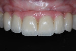 Fig 3. Frontal view of definitive segmented rehabilitation with single implant crowns in the canine region and FDP extending from lateral incisor to lateral incisor. Gingiva-colored ceramics were used to compensate for missing hard and soft tissues.