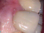 Figure 1  Gingival irritation on tooth No. 9.
