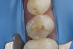 Fig 14. Endodontic treatment completed; significant tooth structure lost to osseous level.
