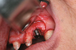 Figure 11  Re-entry at stage II implant uncovering and healing abutment connection.