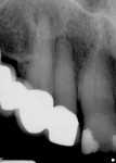 Figure 5  Periapical radiolucency on tooth No. 6.