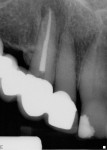 Figure 6  The root canal on tooth No. 6 was obturated.