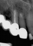 Figure 10  Bone regeneration on teeth Nos. 6 and 7, 18 months after surgery.