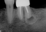 Figure 11  Periapical radiolucency on the distal root of tooth No. 19.
