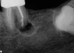 Figure 12  MTA seal on tooth No. 19, distal-buccal, distal-lingual, and isthmus.