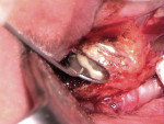 Figure 14  MTA seal in the buccal and lingual canals and adjoining isthmus.