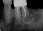 Figure 15  BBone regeneration in tooth No 19, 6 months after surgery.