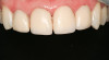 Figure 1  Occlusal view after extraction of tooth No. 27 using Piezosurgery<sup>®</sup> (Piezosurgery Inc, www.piezosurgery.com) and thin-bladed elevators.