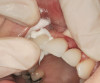 Figure 3a   patient in posttreatment periodontal maintenance program returned with (A) isolated bleeding on probing;