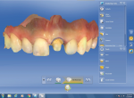 The software’s “Biogeneric Reference” feature was used to design the restoration using the shape, size, and form of tooth No. 8.