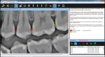Logicon Caries Detector Software