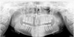 Figure 6  Panoramic radiograph postorthodontics.