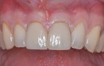 Fig 1. Preoperative situation showing nonrestorable maxillary central incisors.