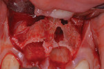 Fig 2. Following extractions, severe alveolar bone destruction caused by endodontic infections was evident.