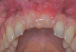Fig 6. Six months after extraction surgery of teeth Nos. 8 and 9 and augmentation, a healthy clinical situation allowed for guided implant placement.