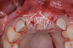 Fig 5. Soft tissues were approximated and sutured, leaving a minimal area of exposed dermal allograft.