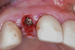 Fig 10. Immediate placement of a 3 mm x 13 mm implant, which was positioned toward the palatal aspect of the extraction socket with primary stability.