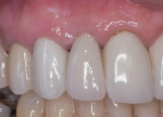 Fig 13. The cement-retained crown, seated on a custom abutment (restorative treatment performed by Howard P. Fraiman, DMD).
