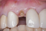 Fig 9. Tooth No. 7, which was previously restored with a crown, had fractured at the gingival margin.