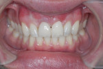 Fig 8. Final restoration of the two implants comprised CAD/CAM abutments and cement-retained zirconia crowns (restorative treatment performed by Brian L. Wilk, DMD).