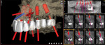 Fig 5. Maxillary implant planning with relationship to digitally planned 3D tooth position and underlying bone based on DICOM files in bucco-lingual cross-sectional dimension.