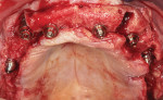Fig 6. Maxillary implant placement using All-on-4 concept plus two additional anterior implants.