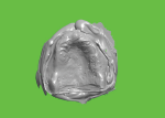 Fig 4. The tissue surface is represented in the alginate or PVS impression model, where all the landmarks are captured. Software shows the digital model of the edentulous area.