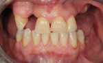 Fig 1. Clinical preoperative intraoral presentation of patient’s dentition