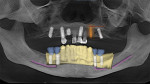 Fig 2. GALILEOS implant plan for all-on-4 protocol with distally tiled posterior implants to extend A-P spread.