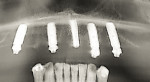 Fig 7. Panoramic postoperative radiograph of SmartFix concept. Three Profile EV implants were used and four abutments were attached during a single-stage surgery. The immediate implant placed in the No. 9 extraction socket
was grafted in a two-stage approach.