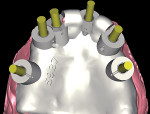 Fig 4. Simplant Safe Guide (Dentsply Sirona) scan with a design for six possible implant sites.
