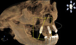 Fig 8. 3D skull view of the right
maxilla depicting implants Nos. 4, 7, and 9 immediately after placement. Note distally tilted implant as part of all-on-4 protocol.