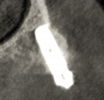 Fig 10. Cross-sectional 3D image of implant No. 13 immediately after placement, after the area of the previous radiolucent lesion had been excised, grafted, healed, and planned with a virtual Profile EV implant. Note how well the implant follows the virtual plan. Each implant was placed with precision.