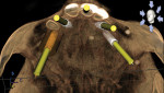 Fig 3. Axial 3D (axial3d.com) skull image of the expected implant sites and trajectory of each fixture (rendering in GALILEOS implant planning software).