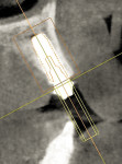 Fig 9. Actual cross-sectional image of implant No. 7 with a straight multibase abutment, well-positioned within bone and using sloped implant to maximize existing bone anatomy. Virtual implant is superimposed over actual fixture.