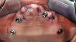 Fig 12. Occlusal view of flapless guided implant surgery completed for implants Nos. 4, 7, 11, and 13 with multibase abutments and grafting of No. 9 two-staged.
