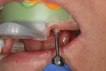 Fig 9. The use of Aquasil Ultra+ Heavy Body material allowed for the capture of all dental landmarks and surrounding soft tissue. In addition, the heavy body material has the firmness to capture an implant pickup for either closed- or open-tray techniques to
maintain accurate orientation. The material, which features a pleasant mint taste, does not overflow.